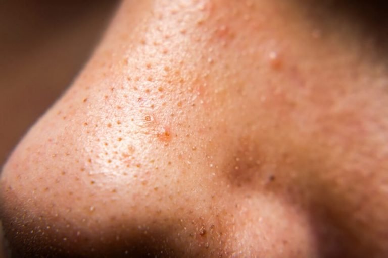 Points noirs et pores dilatés peuvent être éliminés Points noirs et pores dilatés peuvent être éliminés